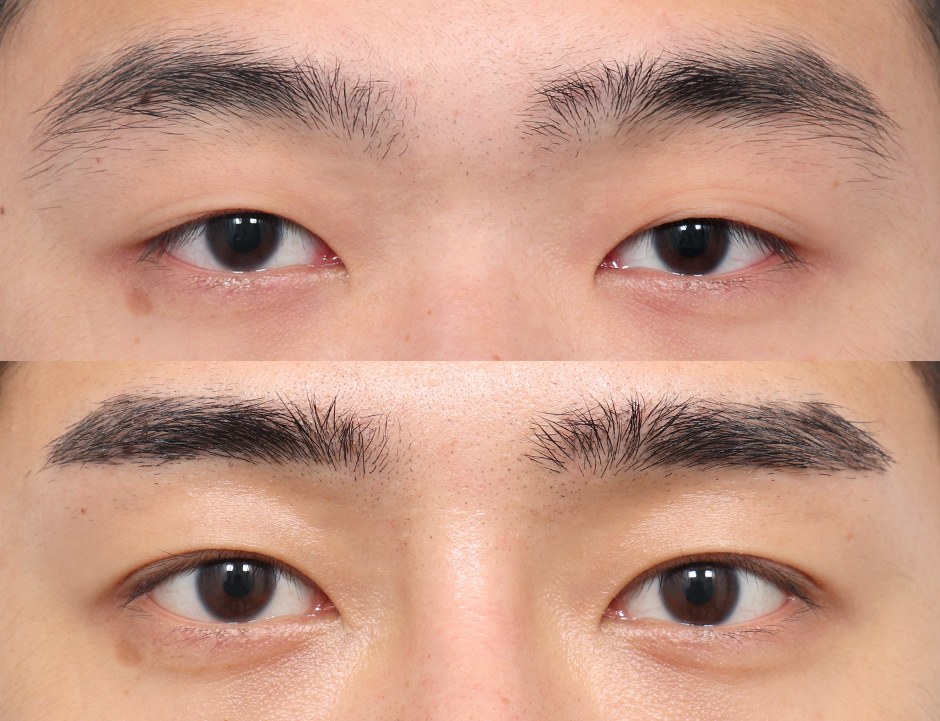 In-line Double Eyelid Surgery Before and After