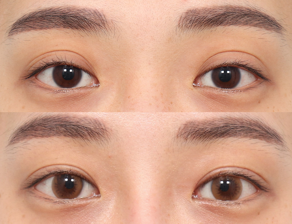 In-outline Double Eyelid Surgery