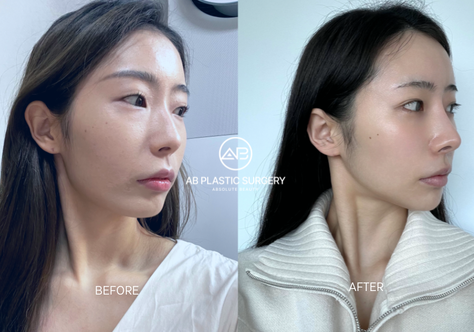 Before and After Plastic Surgery in Korea