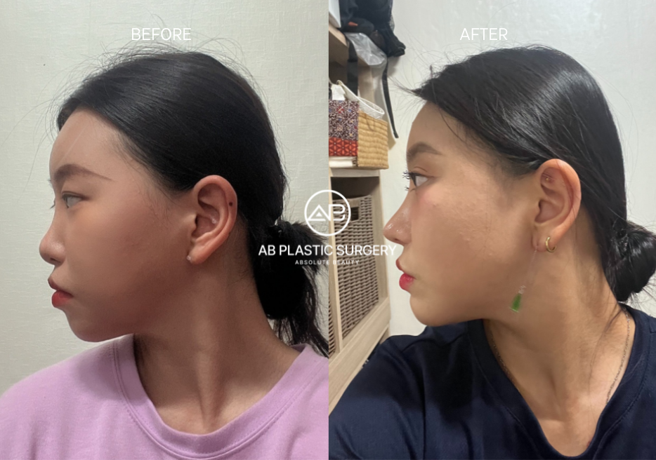 Korean Nose Surgery