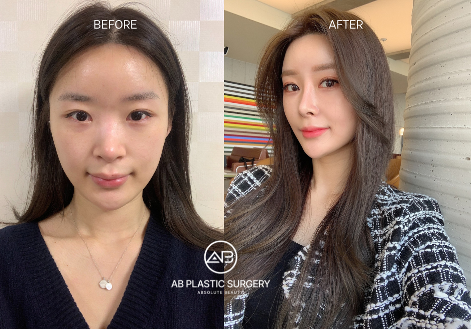 Korean Nose Surgery, Before and After