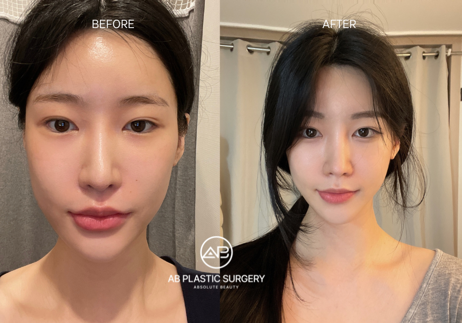 Before and After Plastic Surhery in Korea