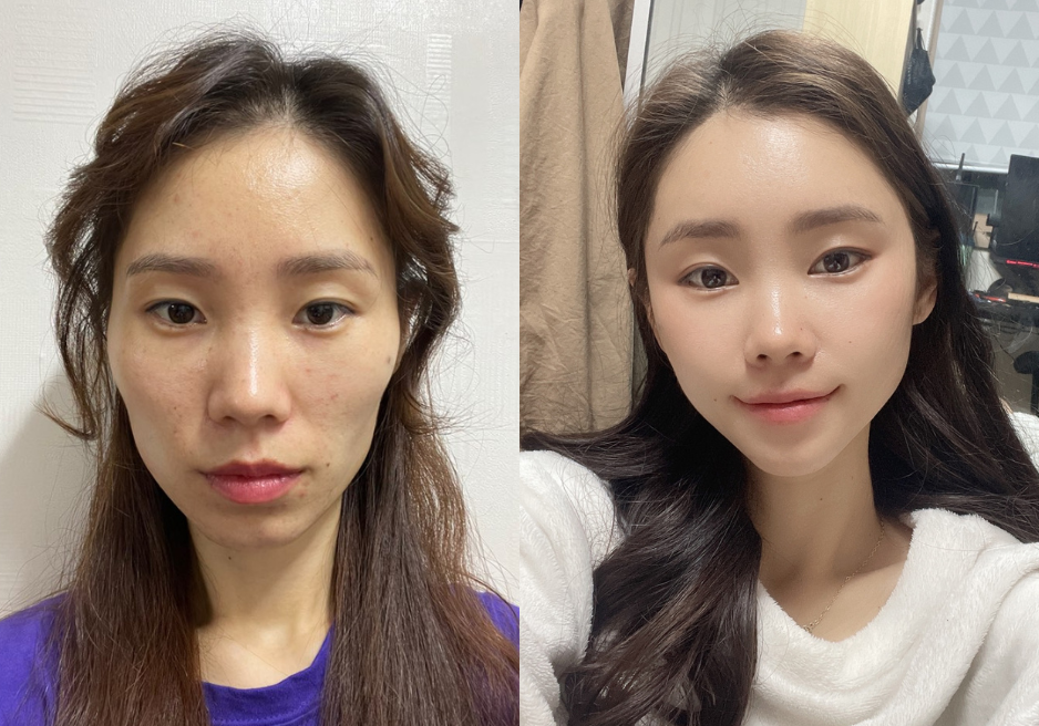 From Botox to Facelifts: Top 10 FAQs on Anti-Aging in Korea | AB Plastic Surgery Korea