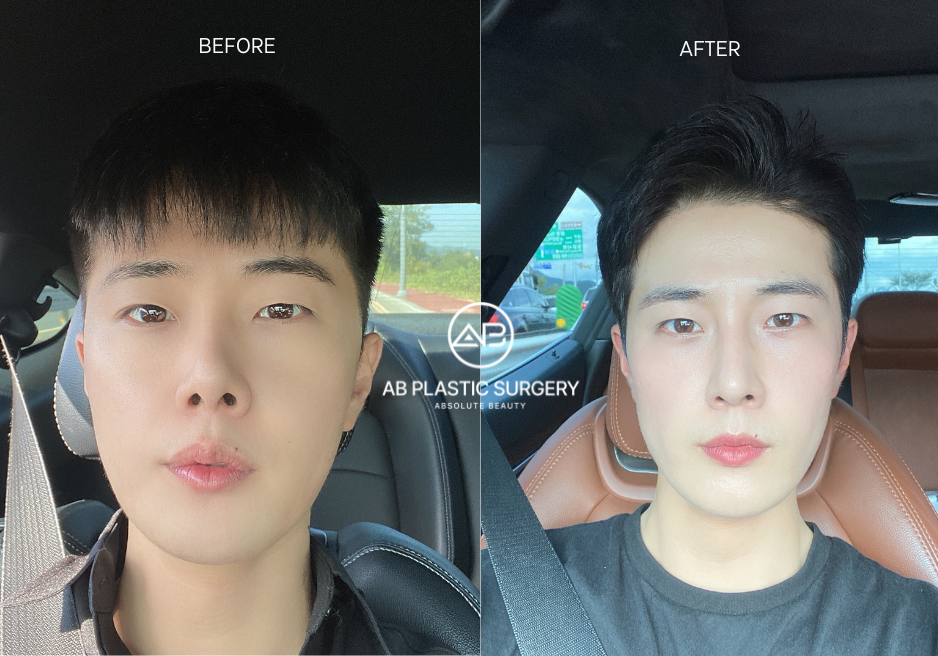 Male Rhinoplasty in Korea