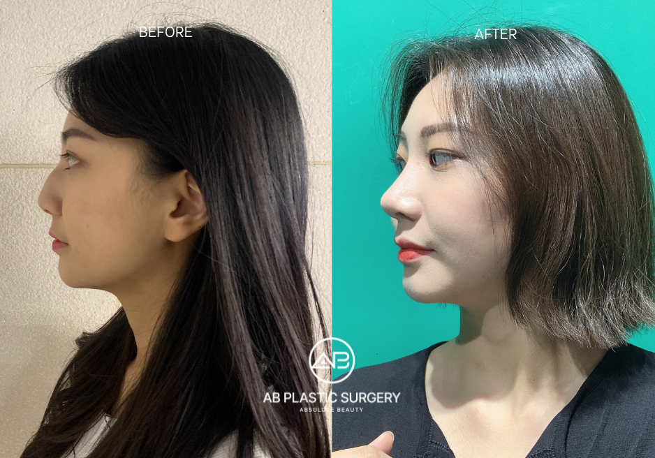 Nose Job in Korea Before and After