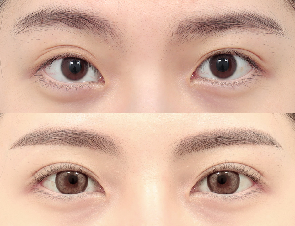 Outline Double Eyelid Surgery Result