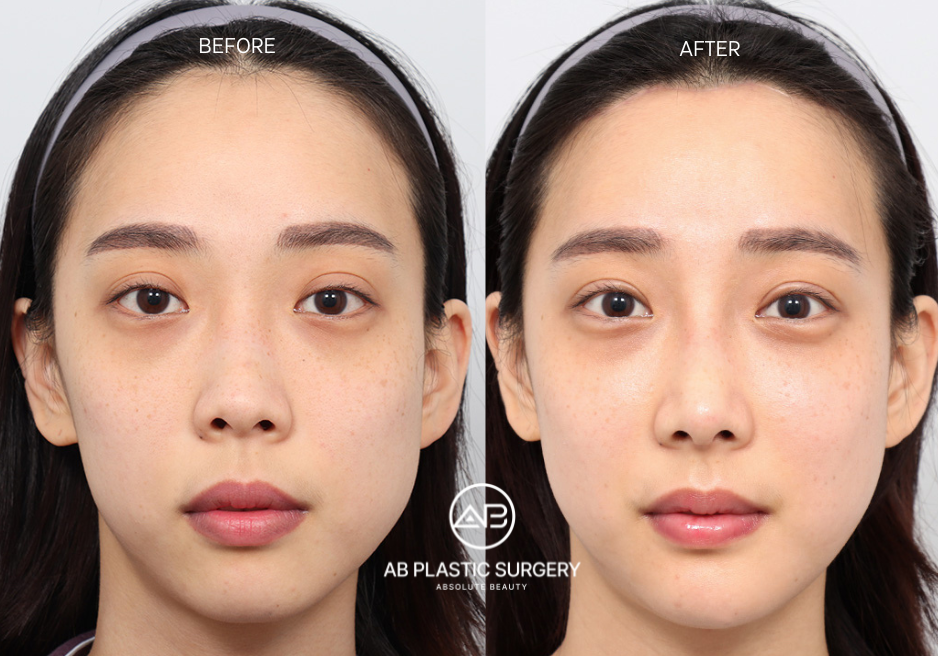 Results of Forehead Reduction Surgery in Korea