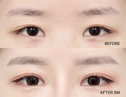 Revisional Eye Surgery in Korea