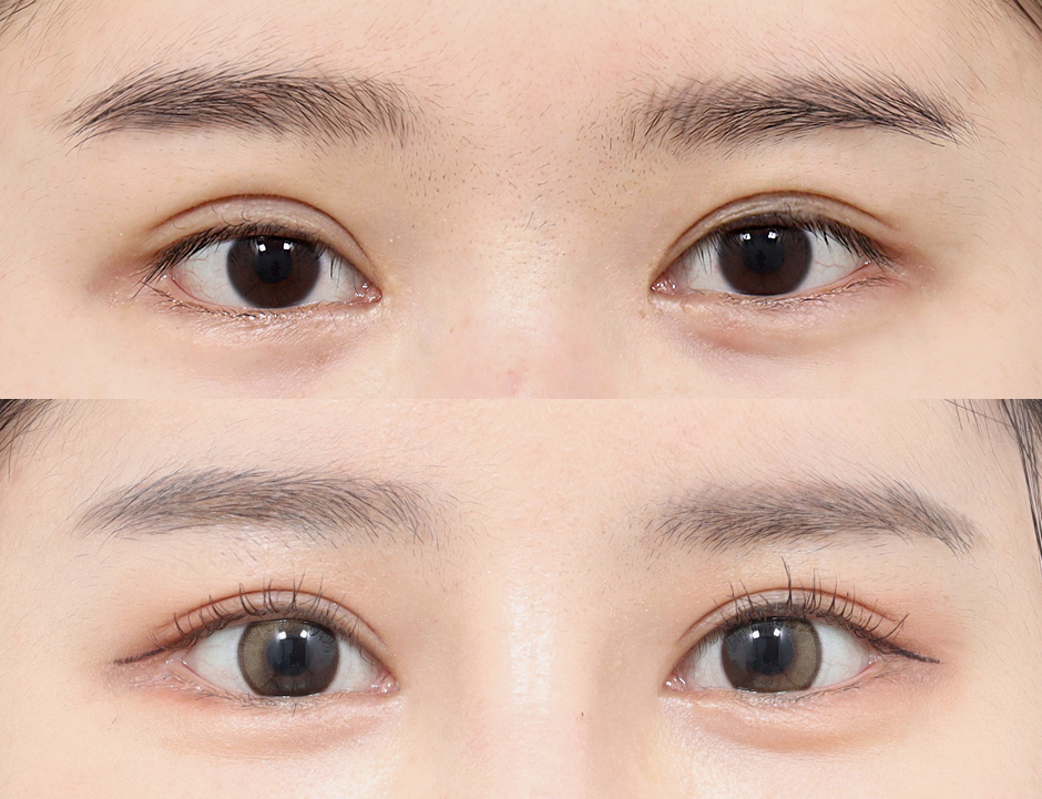 Semi-outline Double Eyelid Surgery Korea