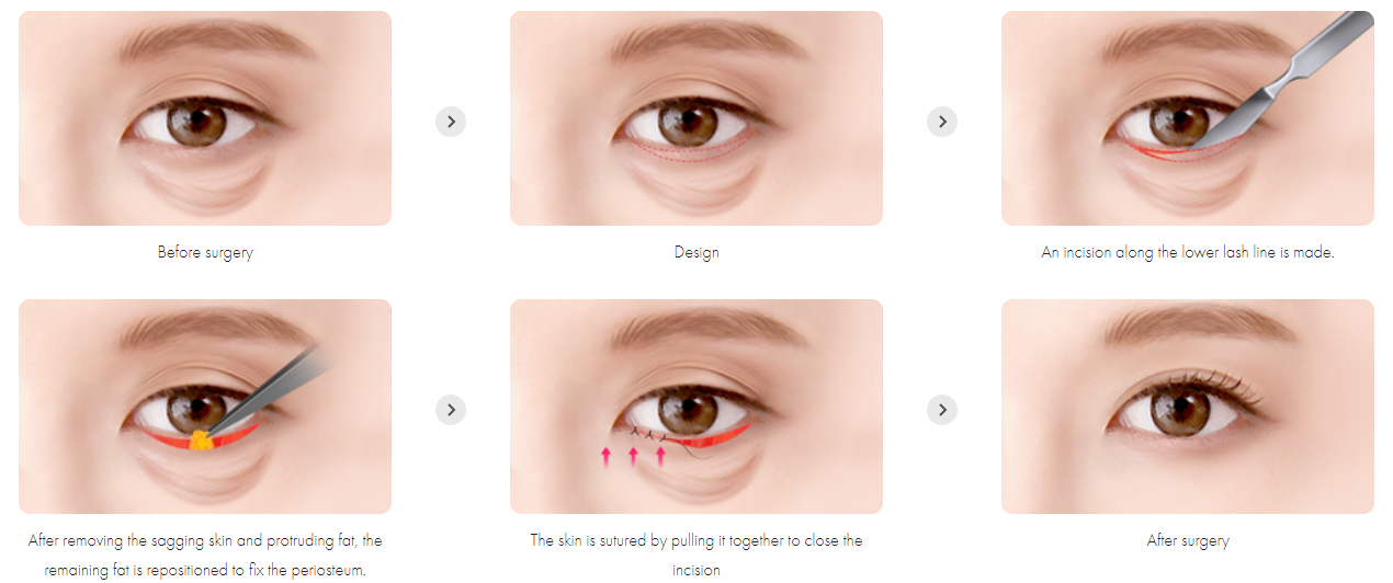 Plastic Surgery For Under Eye Bags