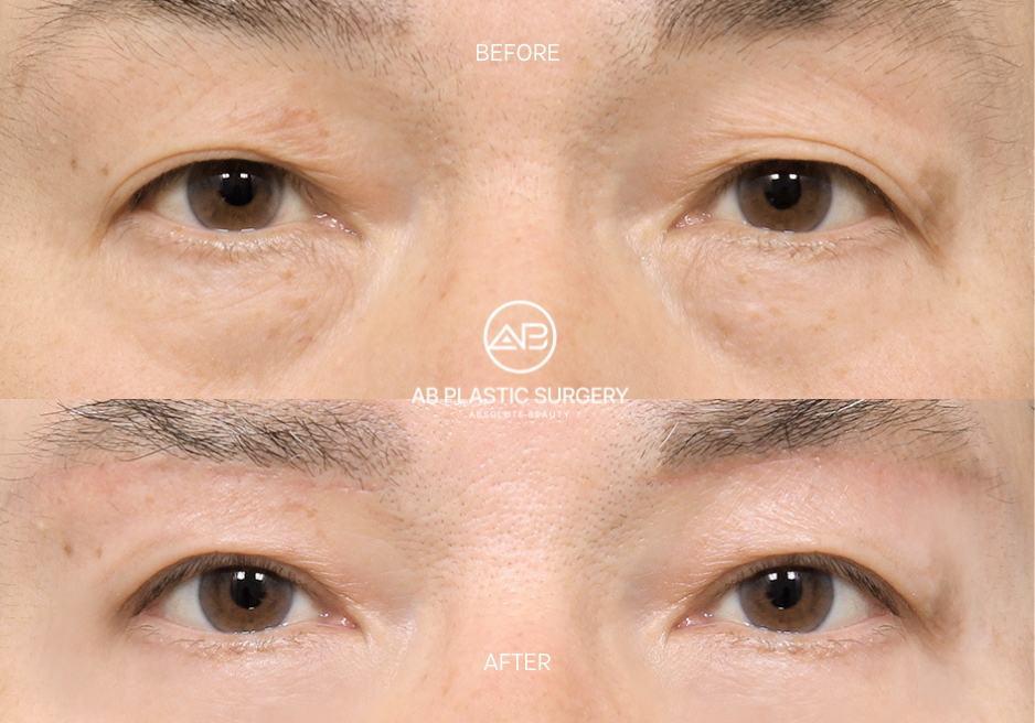 Before and After Under Eye Bag Surgery in Korea