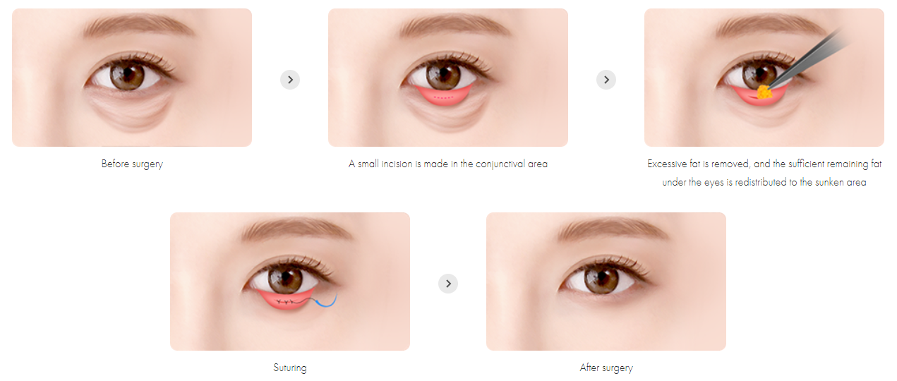 Under Eye Fat Repositioning