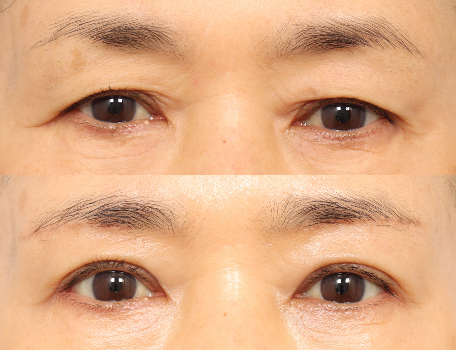 Endotine Implant Brow Lift in Korea