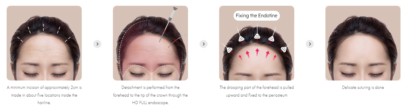 Endotine Implant Forehead Lift