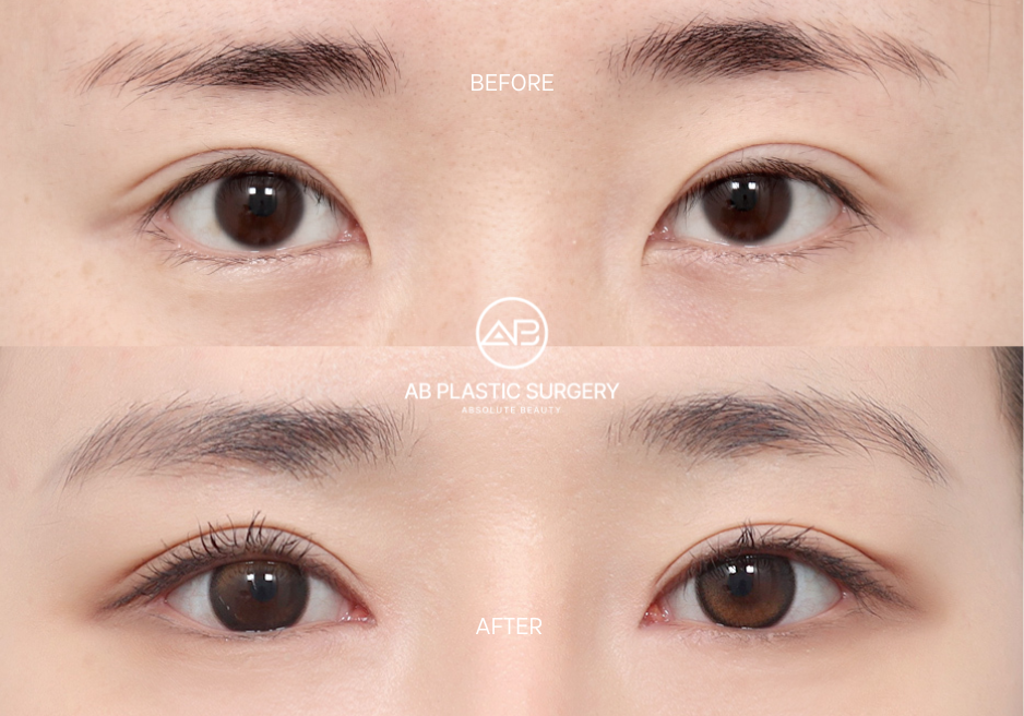 Lateral and Lower Canthoplasty Surgery Results