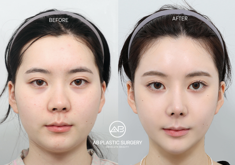 Before and After Facial Contouring Surgery in Korea