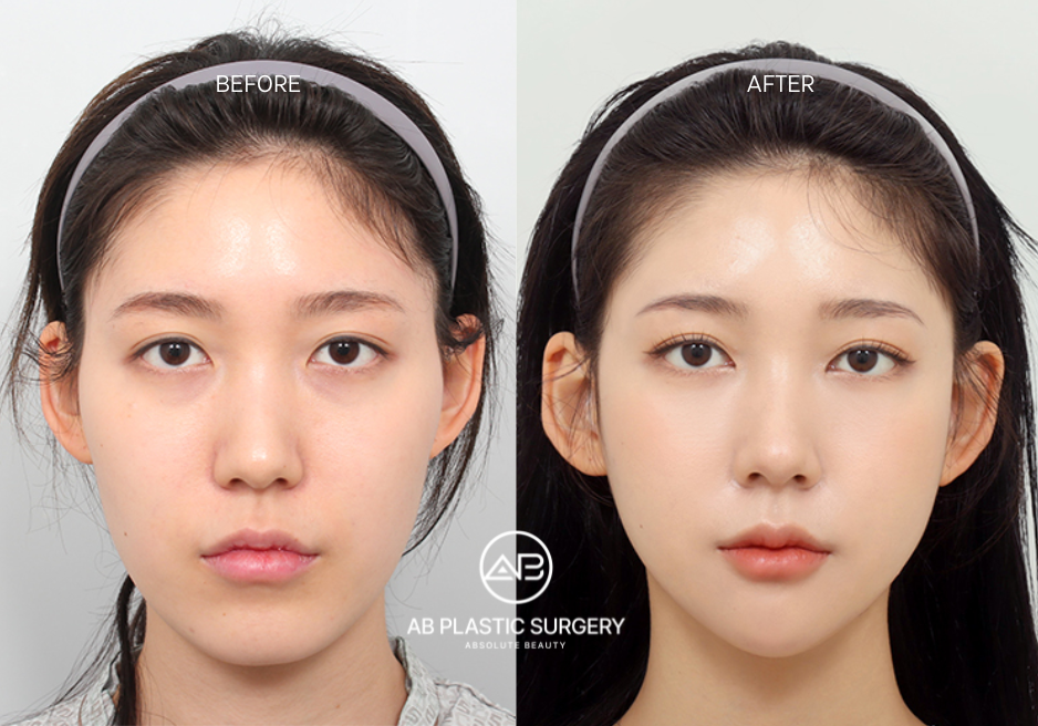 Facial Contouring Plastic Surgery in Korea