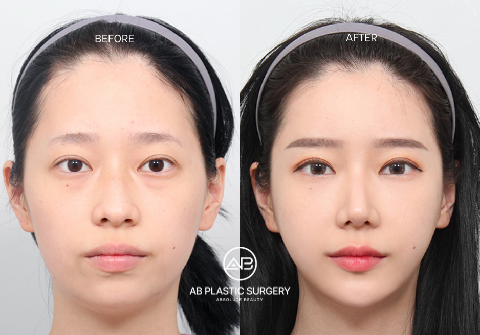 Facial Contouring Surgery Korea Results