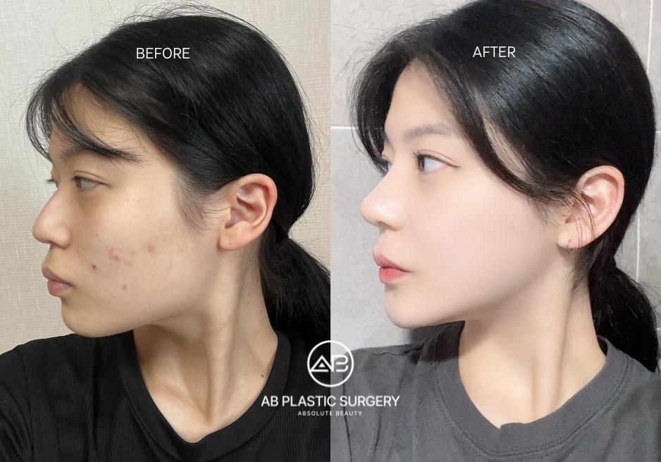 Bulbous Nose Surgery Korea