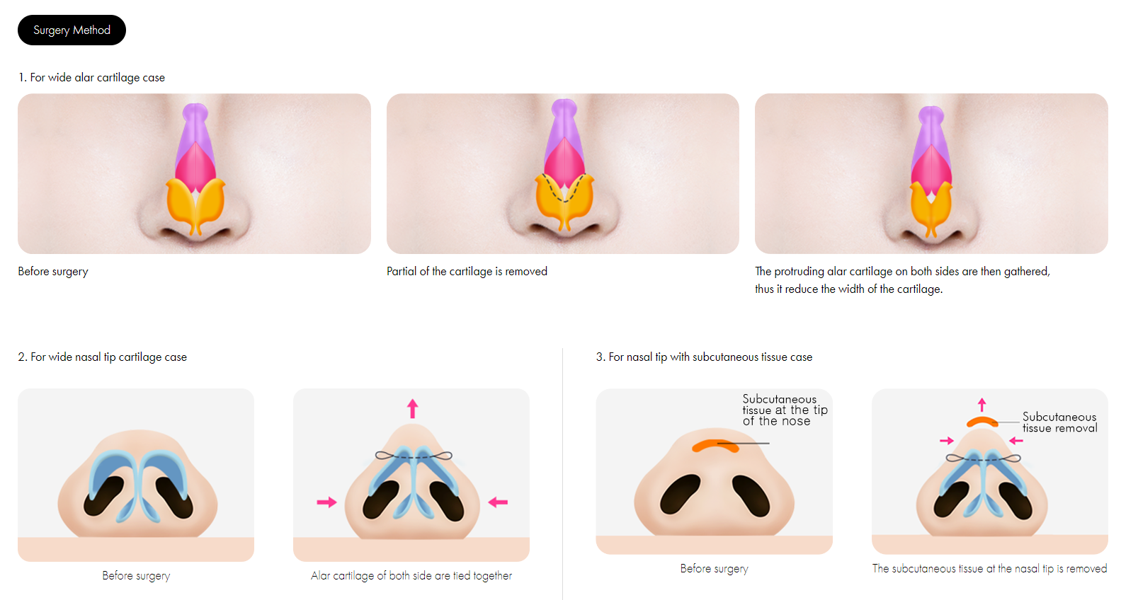 Bulbous Nose Surgery Korea