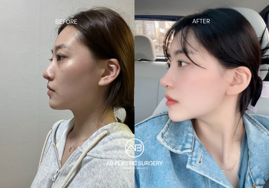 Bulbous Nose Rhinoplasty