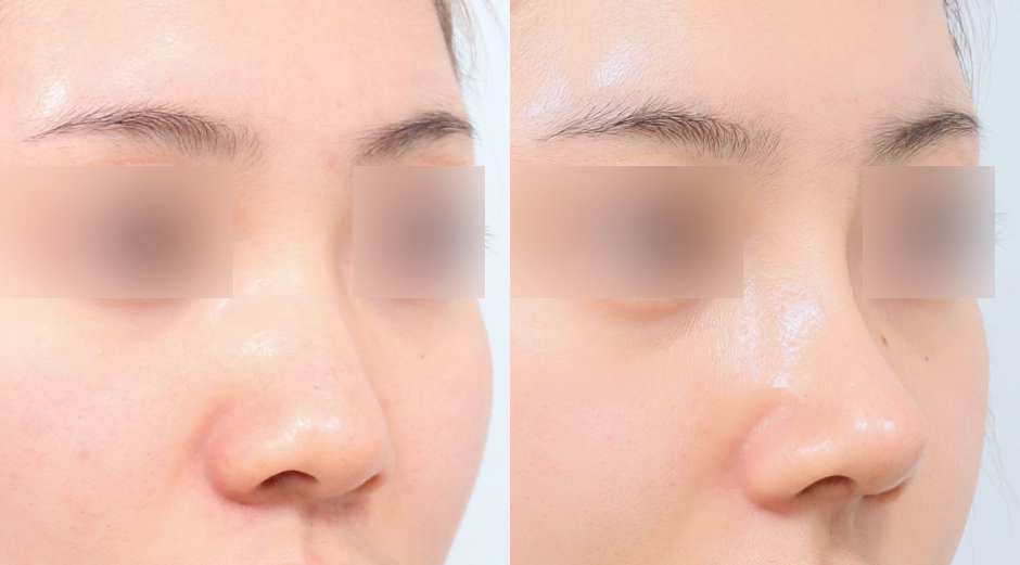 Implant Free Rhinoplasty in Korea