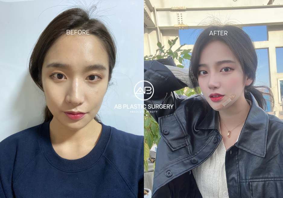 Double Eyelid Surgery Before and After