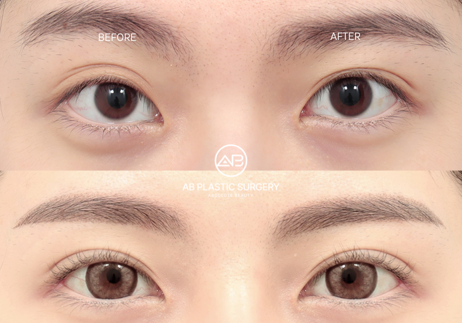 Double Eyelid Surgery in Korea Before After