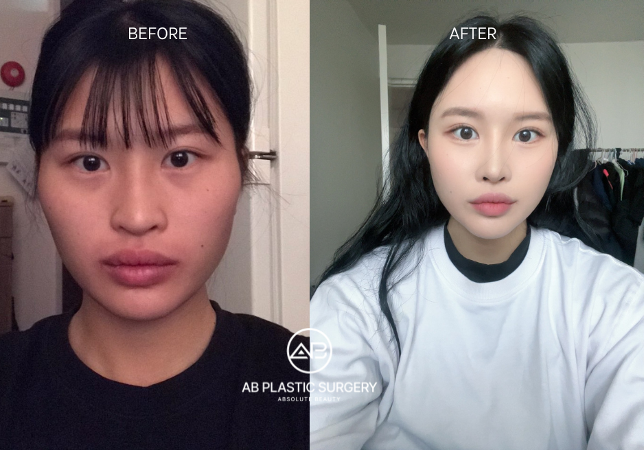 Facial Contouring in Korea