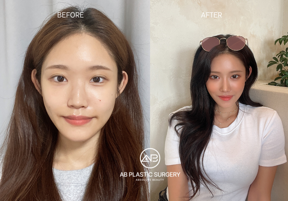 Facial Contouring in Korea