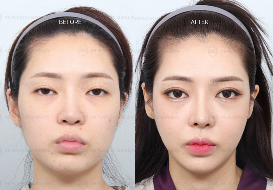 Facial Contouring in Korea