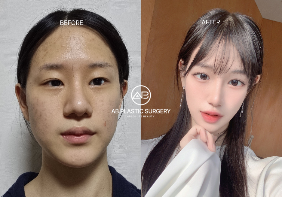 Facial Contouring Before and After