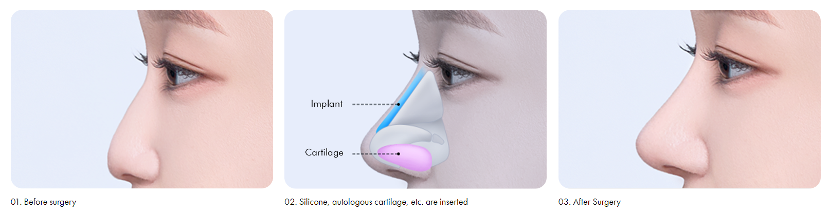 Flat Nose Rhinoplasty Korea