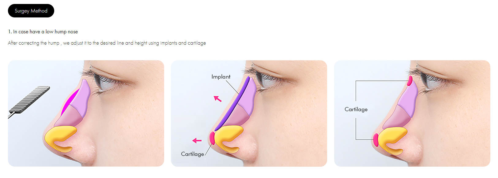 Hump Nose Rhinoplasty in Korea