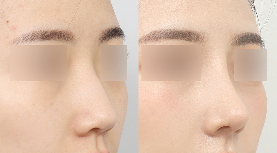 Implant Free Nose Job Korea