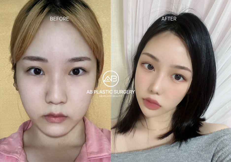 Korean Beauty Standards-V-line Face and Straight Nose