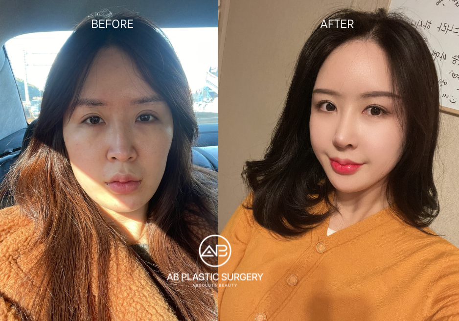 Double Eyelid Surgery Revision Before and After