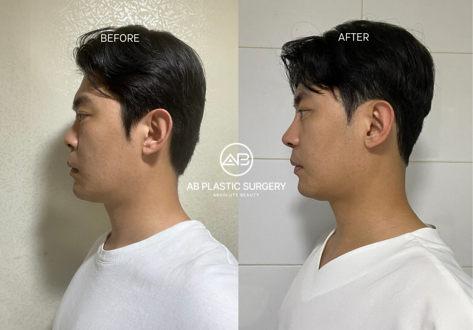 Male Nose Job Korea