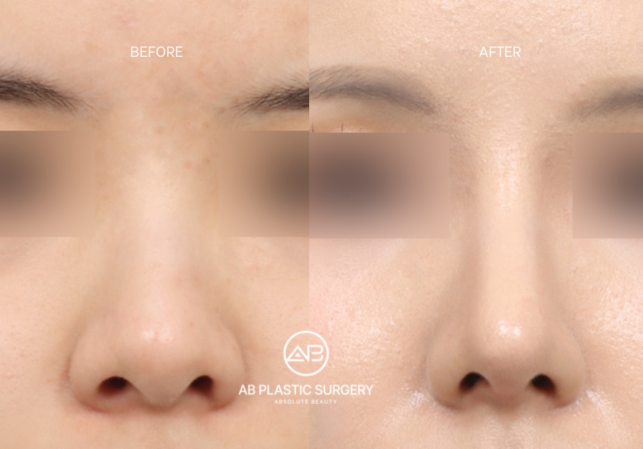 Rhinoplasty at AB Plastic Surgery Korea