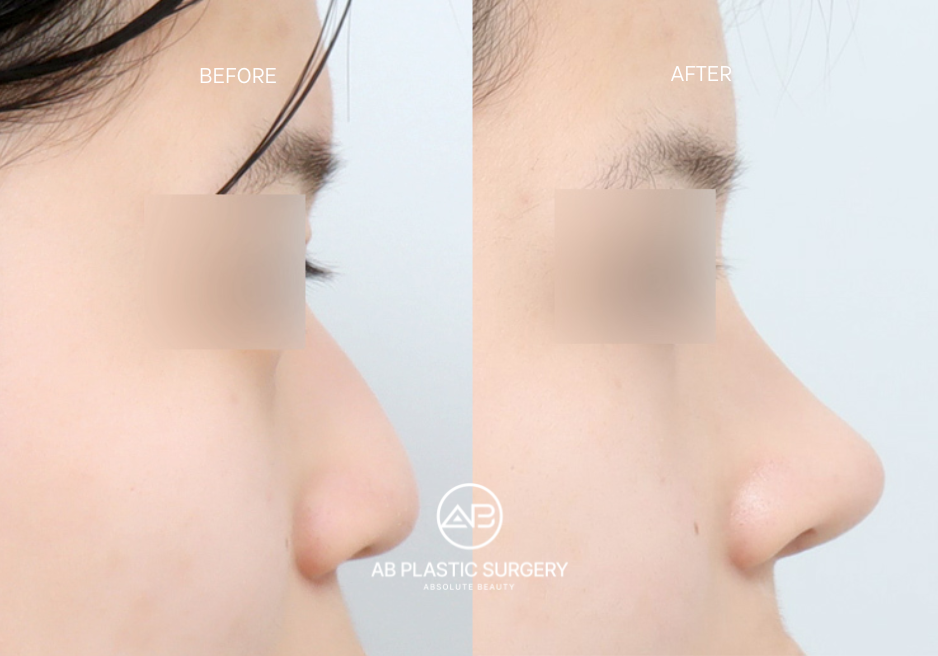 Before and Aftrer Rhinoplasty in Korea