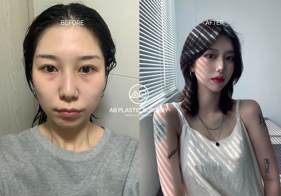 Korean Beauty Standards and Plastic Surgery