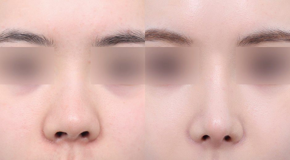 Implant Free Rhinoplasty Korea. Before and After