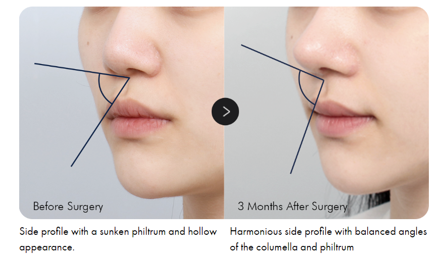 Short Nose Surgery Before and After