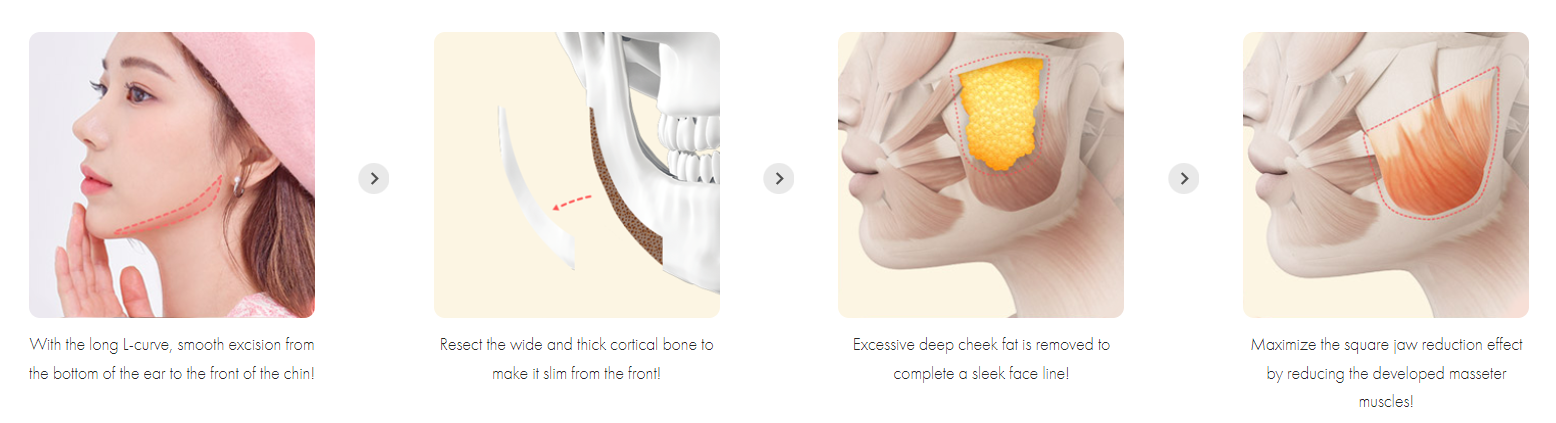 Square Jaw Reduction Surgery Procedure