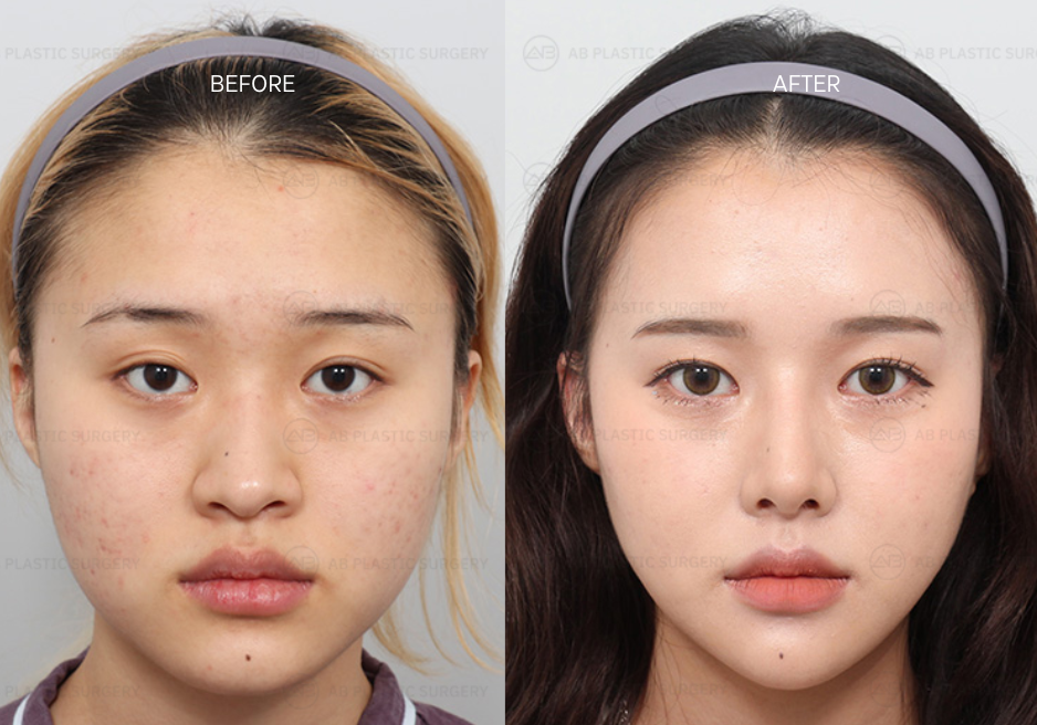 Before and After Rhinoplasty at AB Plastic Surgery Korea