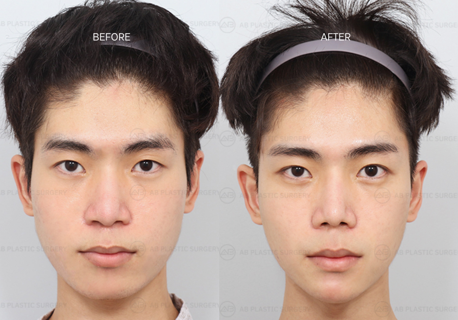 Glasses After Rhinoplasty