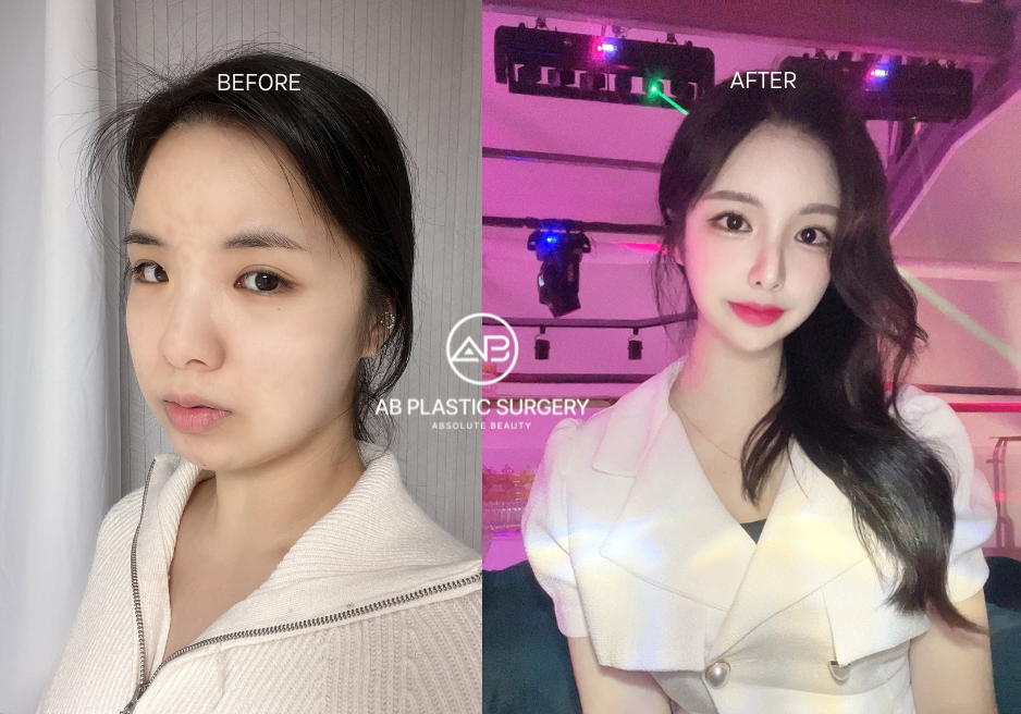 Top 8 Wide Face Surgery How to Achieve Narrower and Smaller Face AB Plastic Surgery Korea