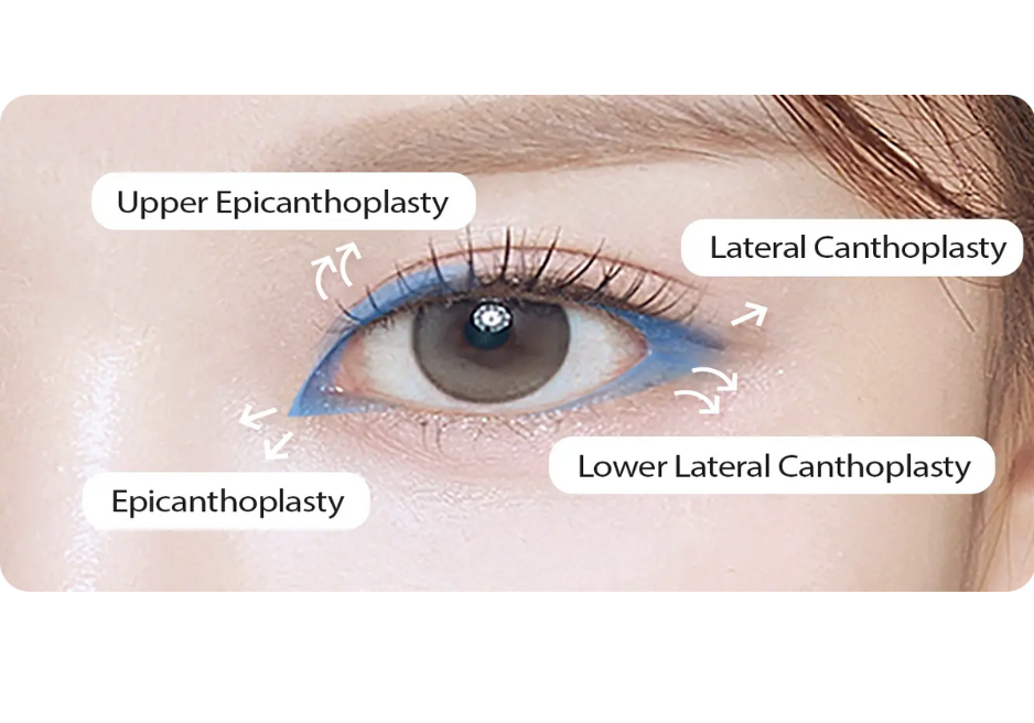 almond-eye-surgery-canthoplasty-methods