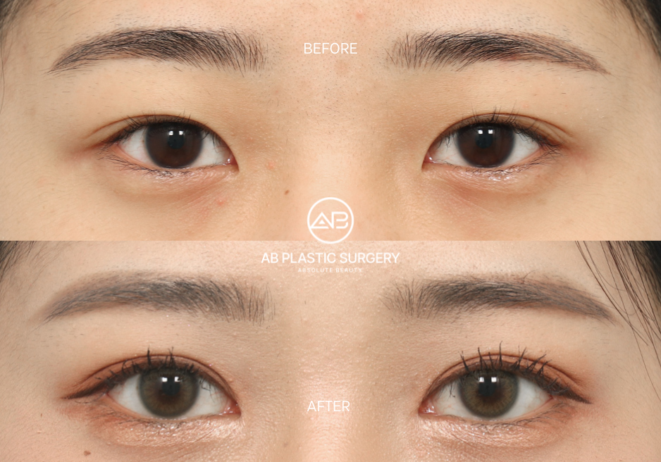 almond-eye-surgery-canthoplasty-results