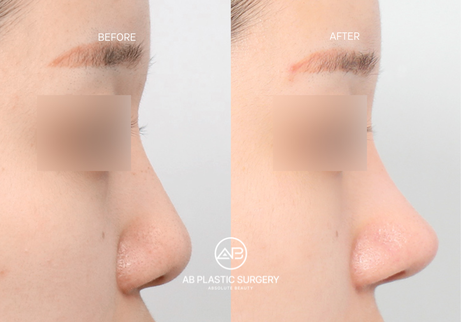 flat-nose-rhinoplasty-korea-before-after